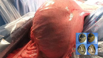 Enterolitíase em cólon transverso - relato de caso